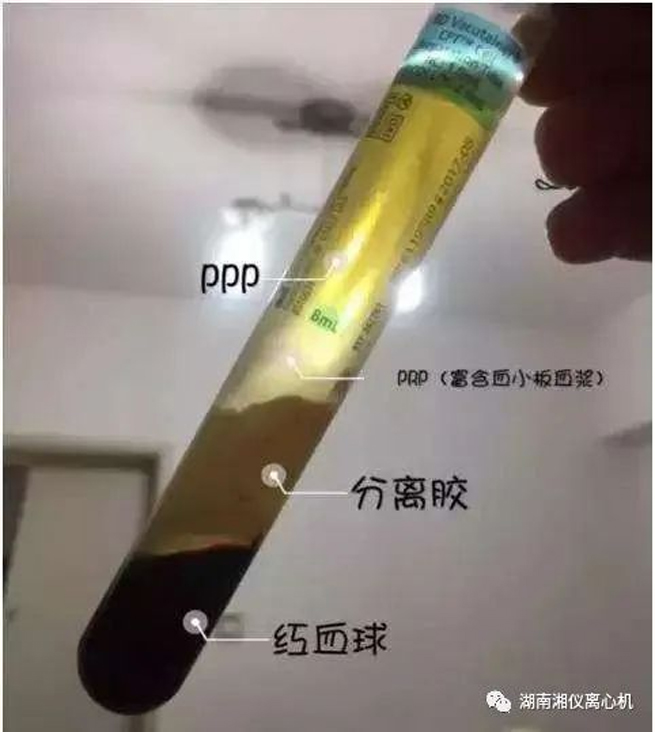 Automologe Serum schönheit PRP Automologe Serum schönheit PRP